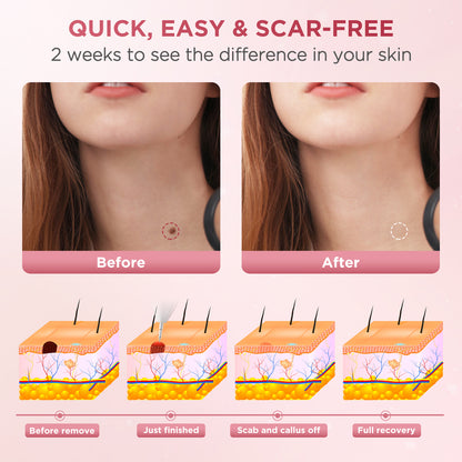 Ophera Skin Tag and Mole Removal Kit